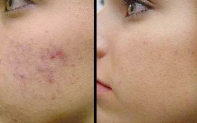 La mejor solución para eliminar el acné